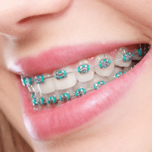 Aparelho Ortodôntico CONVENCIONAL