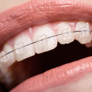 Aparelho Ortodôntico ESTÉTICOS